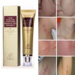 TCM Scar and Acne Remover Gel