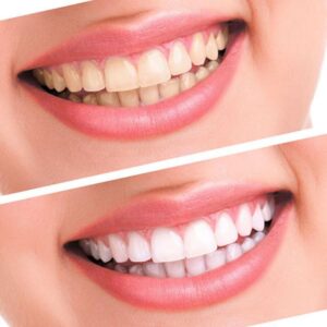 Hot-Teeth-Whitening-44-Peroxide-Dental-Bleaching-System-Oral-Gel-Kit-Tooth-Whitener-Dental-Equipment_1_1800x_715480c0-7e57-4b56-91c2-5bdbe54a26ec